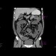 ileus, small bowel obstruction on terminal ileum: CT - Computed tomography